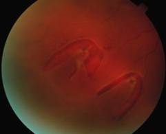 Два клапанных разрыва сетчатки Два клапанных разрыва сетчатки