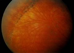 Решетчатая дегенерация сетчатки Решетчатая дегенерация сетчатки