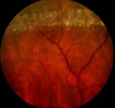 Дегенерация сетчатки типа «след улитки» Дегенерация сетчатки типа «след улитки»