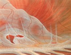 Тракционное воздействие стекловидного тела на область клапанного разрыва сетчатки